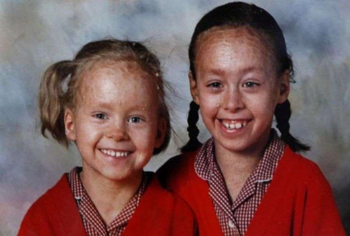 Two sister Body turns in to Snack in indore reason is lameller ichthyosis diseases