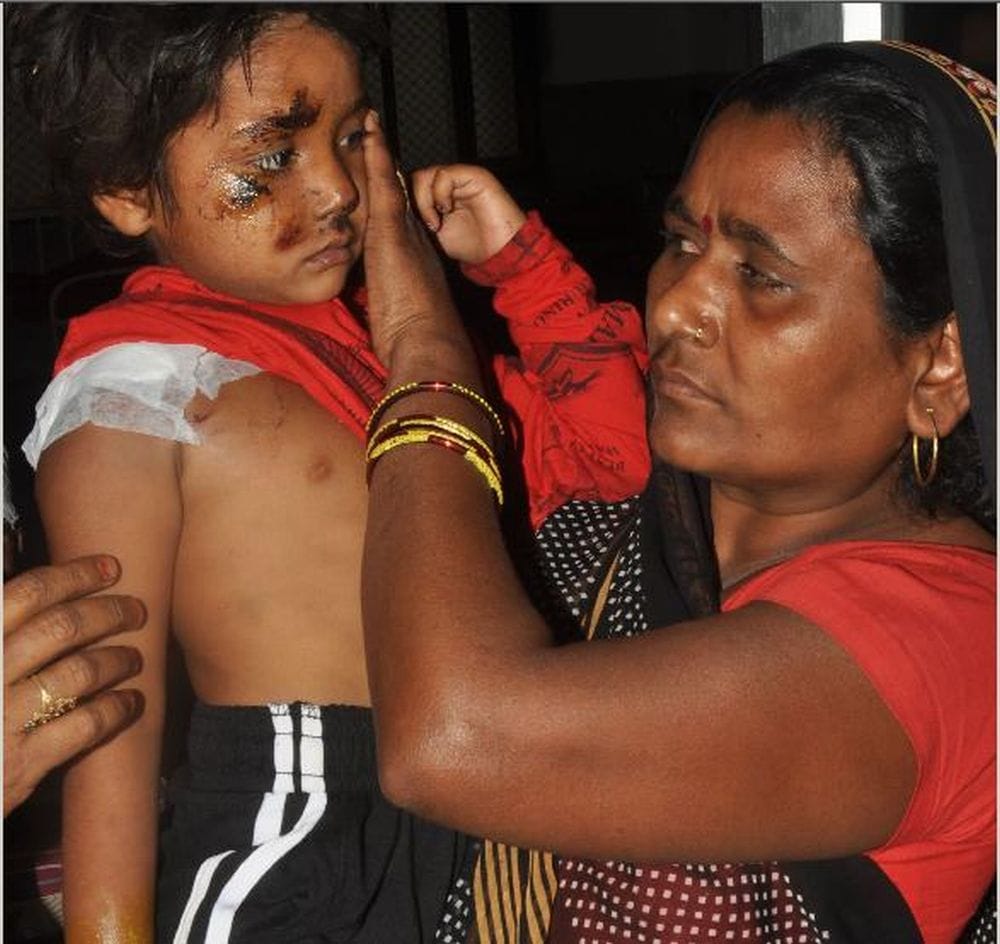 agra storms victim six year old manavi admitted in SN hospital