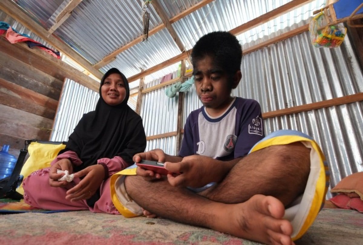 This indonesian boy suffers with genetic disorder called werewolf
