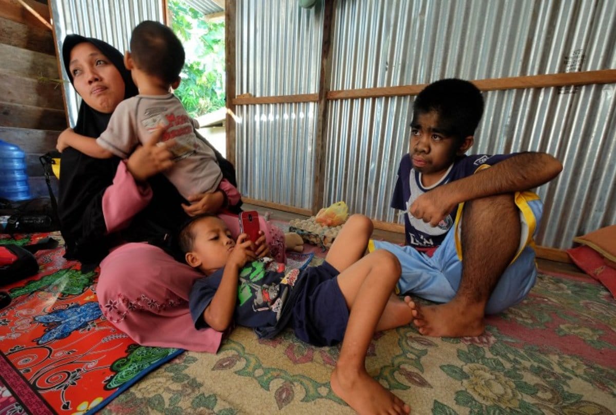 This indonesian boy suffers with genetic disorder called werewolf