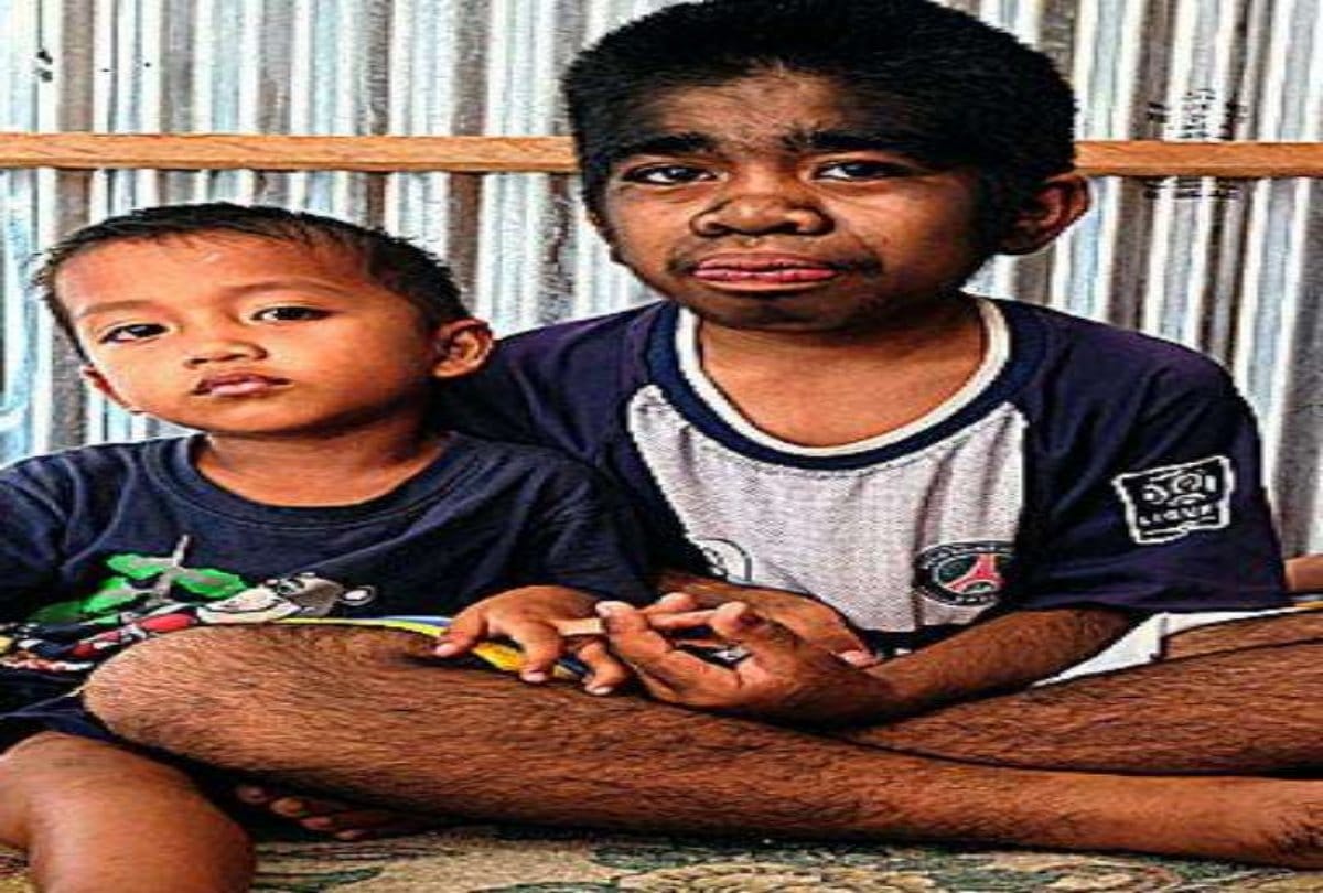 This indonesian boy suffers with genetic disorder called werewolf