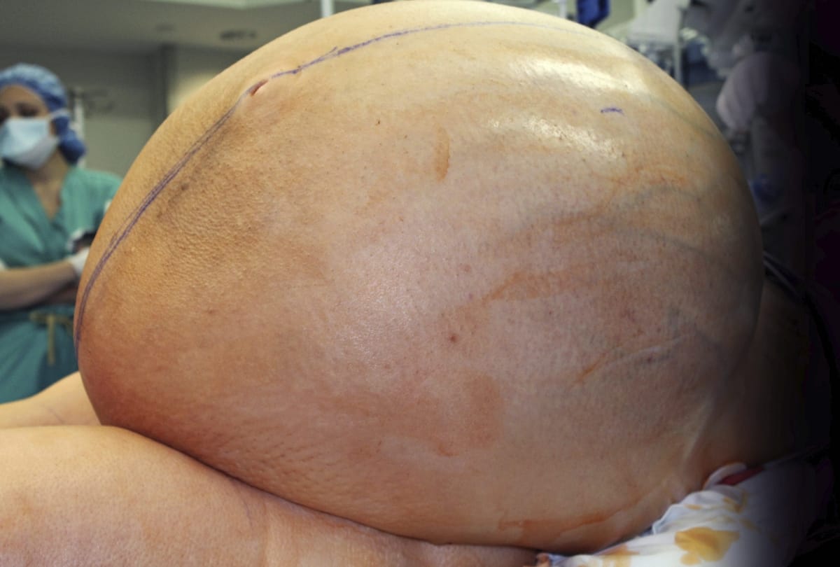 A large tumor is prepared to be removed from a patient in Danbury