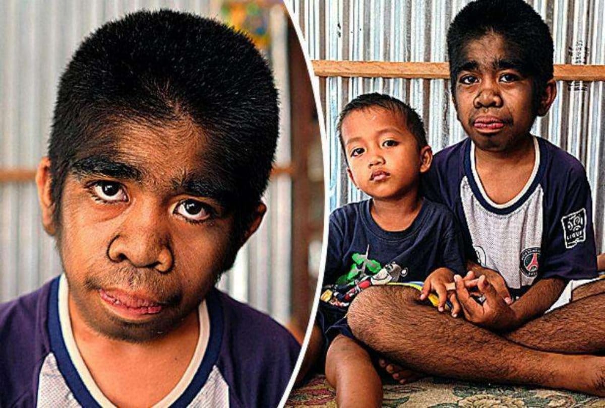 This indonesian boy suffers with genetic disorder called werewolf