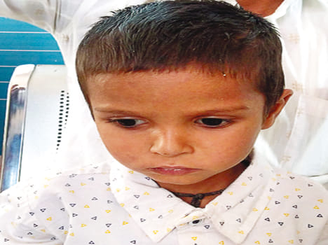 चिकनपाक्स से पीड़ित मासूम 