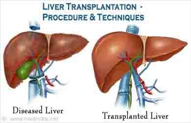 with the new technology Liver will be kept  safe for 24 hours before transplantation