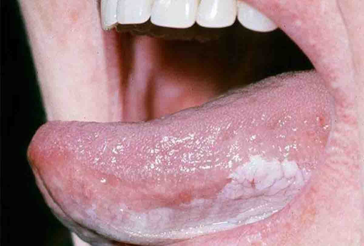 First operation of tongue cancer in medical college banda