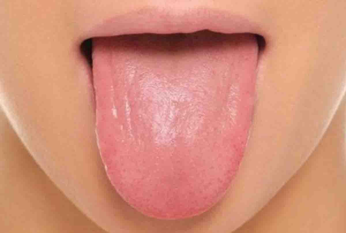 First operation of tongue cancer in medical college banda