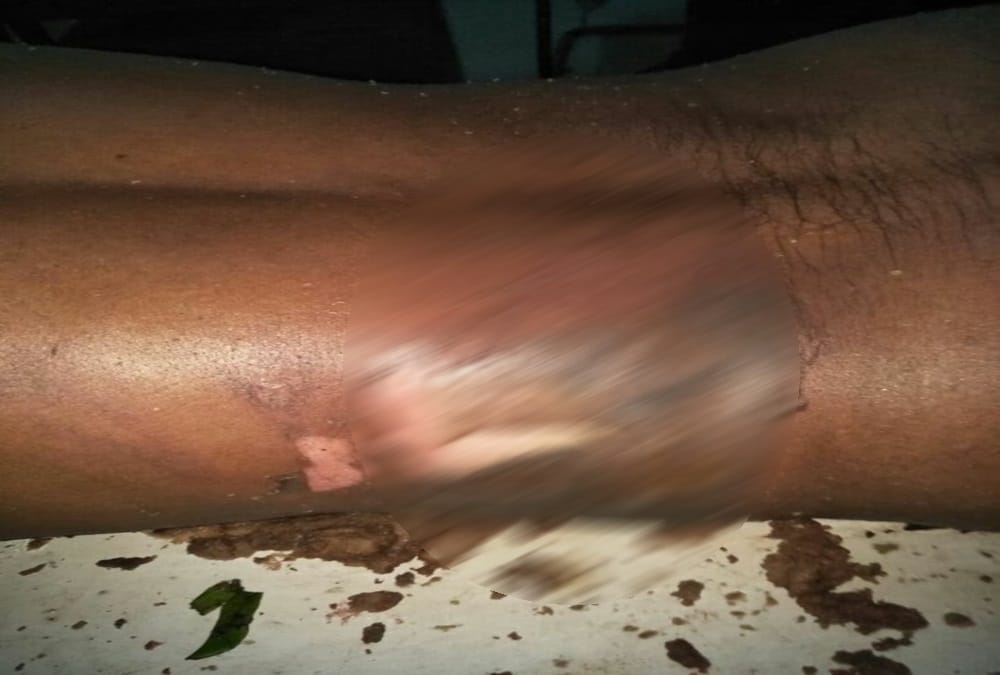 Drunk youths throw shopkeeper into Boiling oil in nainital