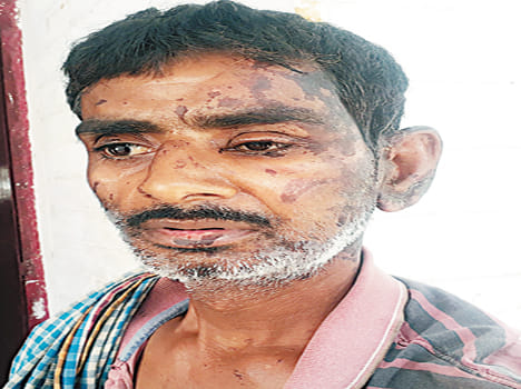 acid thrown on rickshaw driver