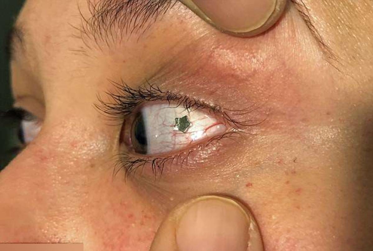Doctor eyeball piercing on rare patient at new york