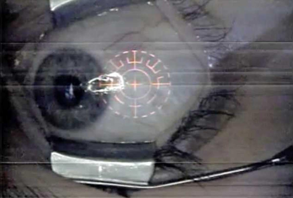 Doctor eyeball piercing on rare patient at new york