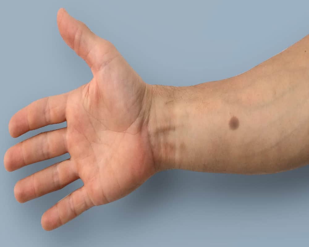 Moles on these parts of body indicates about the bad luck