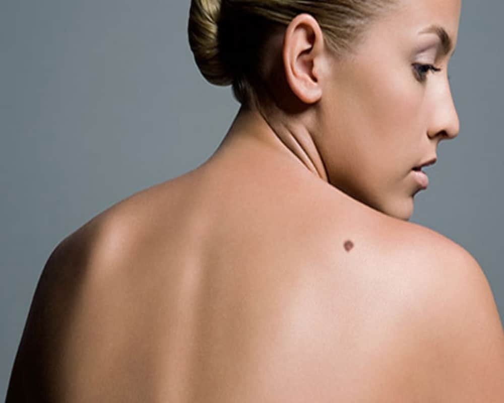 Moles on these parts of body indicates about the bad luck