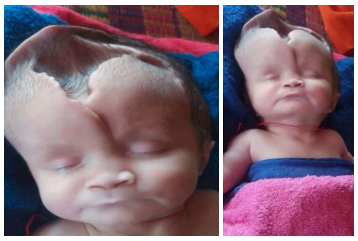 Skull less Baby Girl Born In Cambodia Diagnosed With Anencephaly Or Open Skull