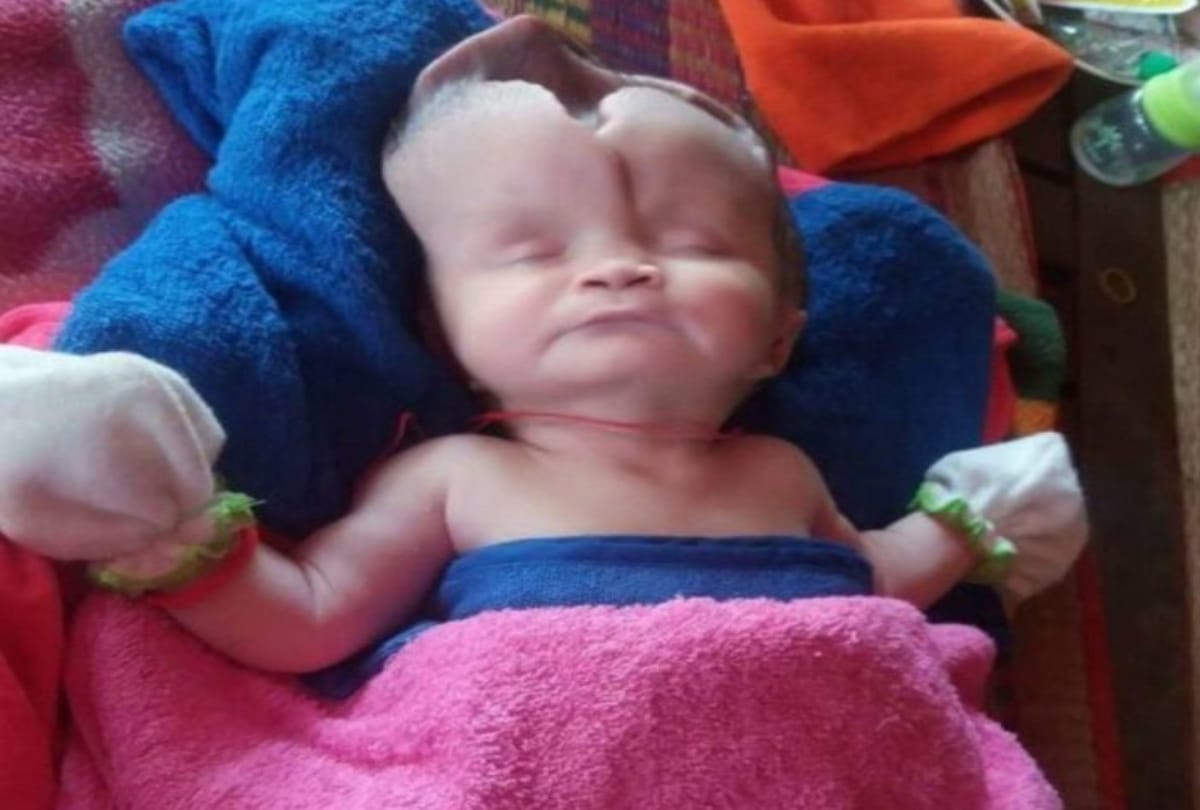 Skull less Baby Girl Born In Cambodia Diagnosed With Anencephaly Or Open Skull