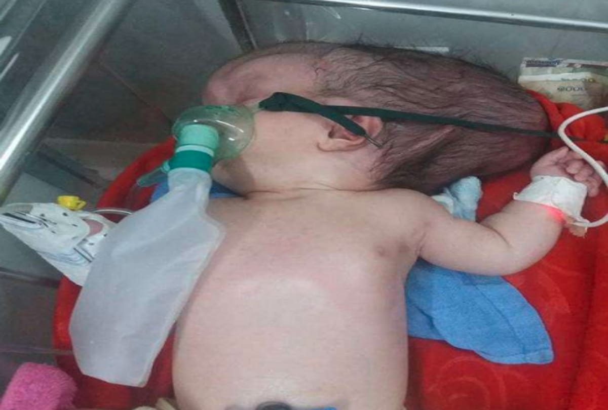 Skull less Baby Girl Born In Cambodia Diagnosed With Anencephaly Or Open Skull