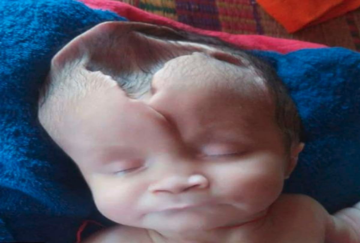 Skull less Baby Girl Born In Cambodia Diagnosed With Anencephaly Or Open Skull