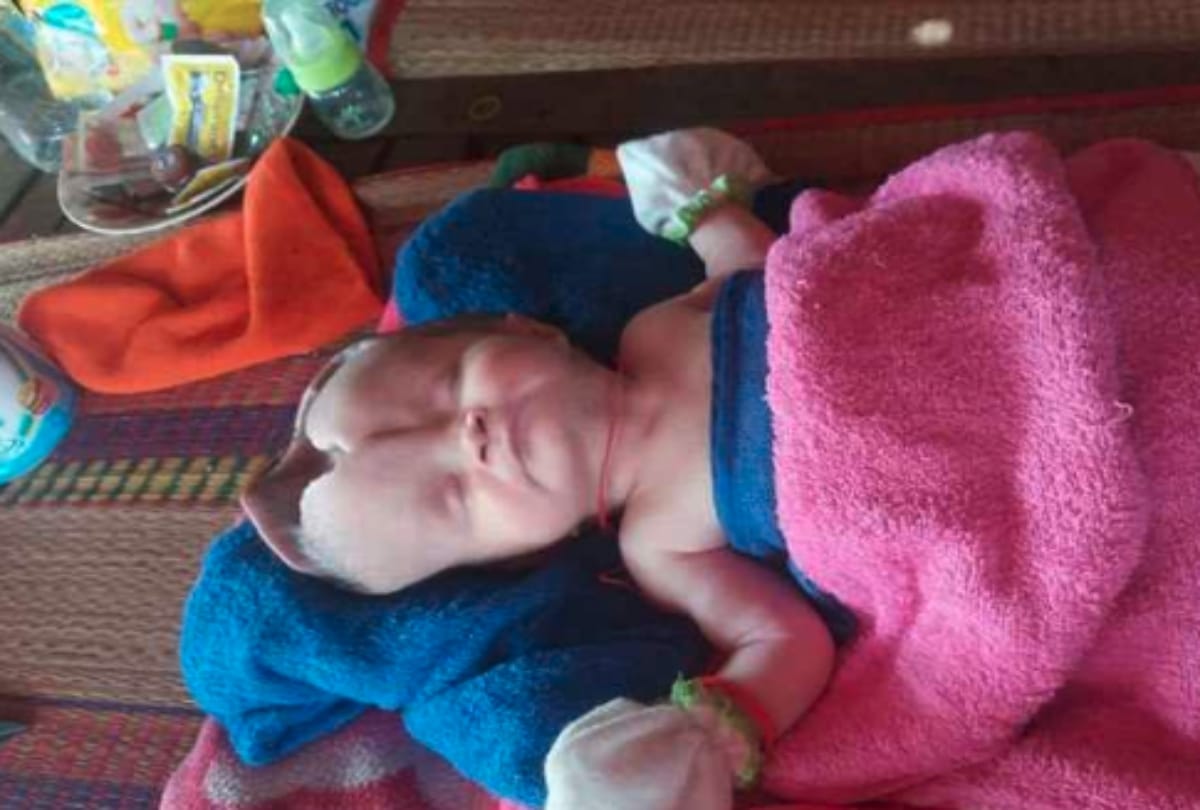 Skull less Baby Girl Born In Cambodia Diagnosed With Anencephaly Or Open Skull