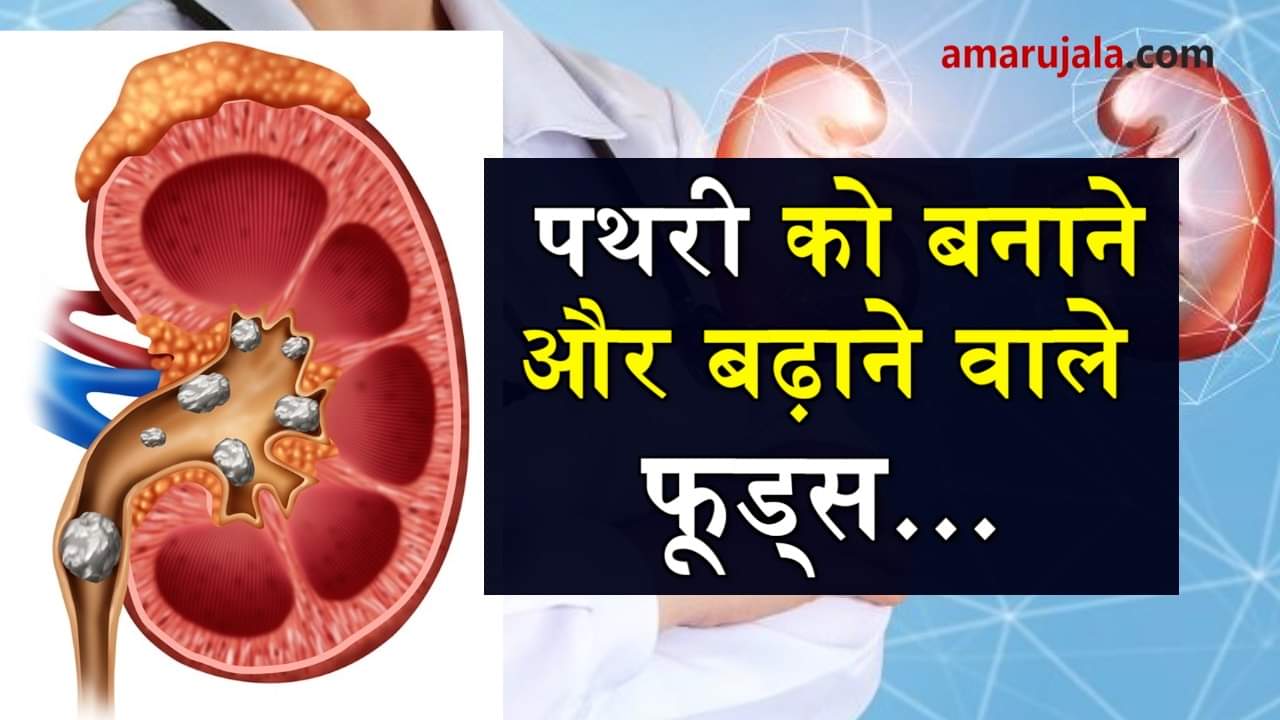 foods can cause you kidney stone