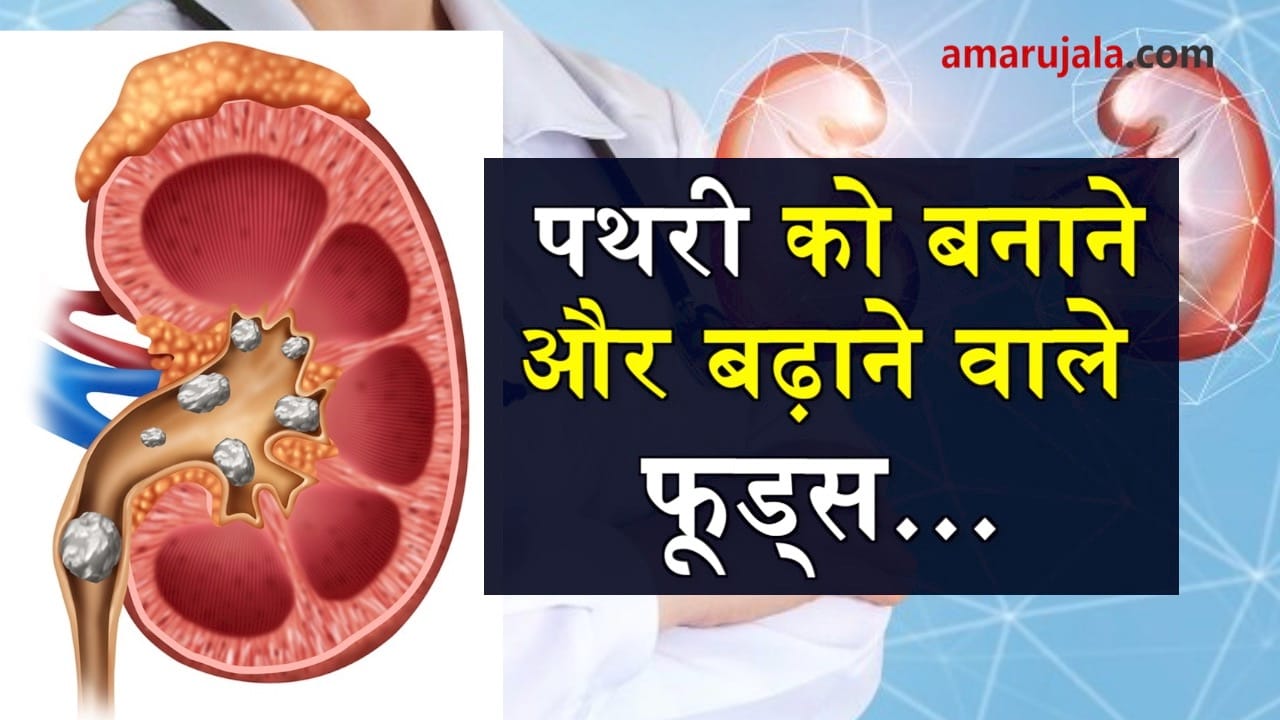 foods can cause you kidney stone