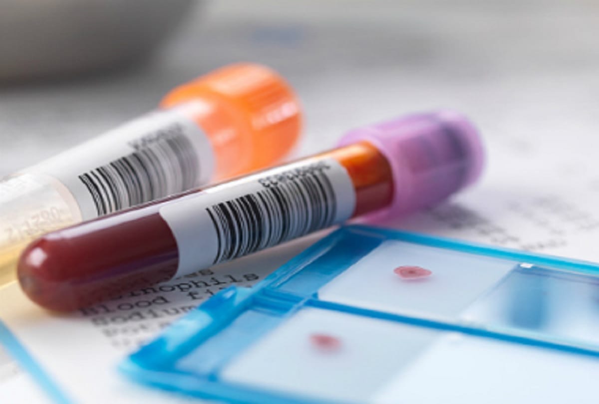 What is Bombay Blood Group, Demand for this rare blood group increased in Mumbai hospitals