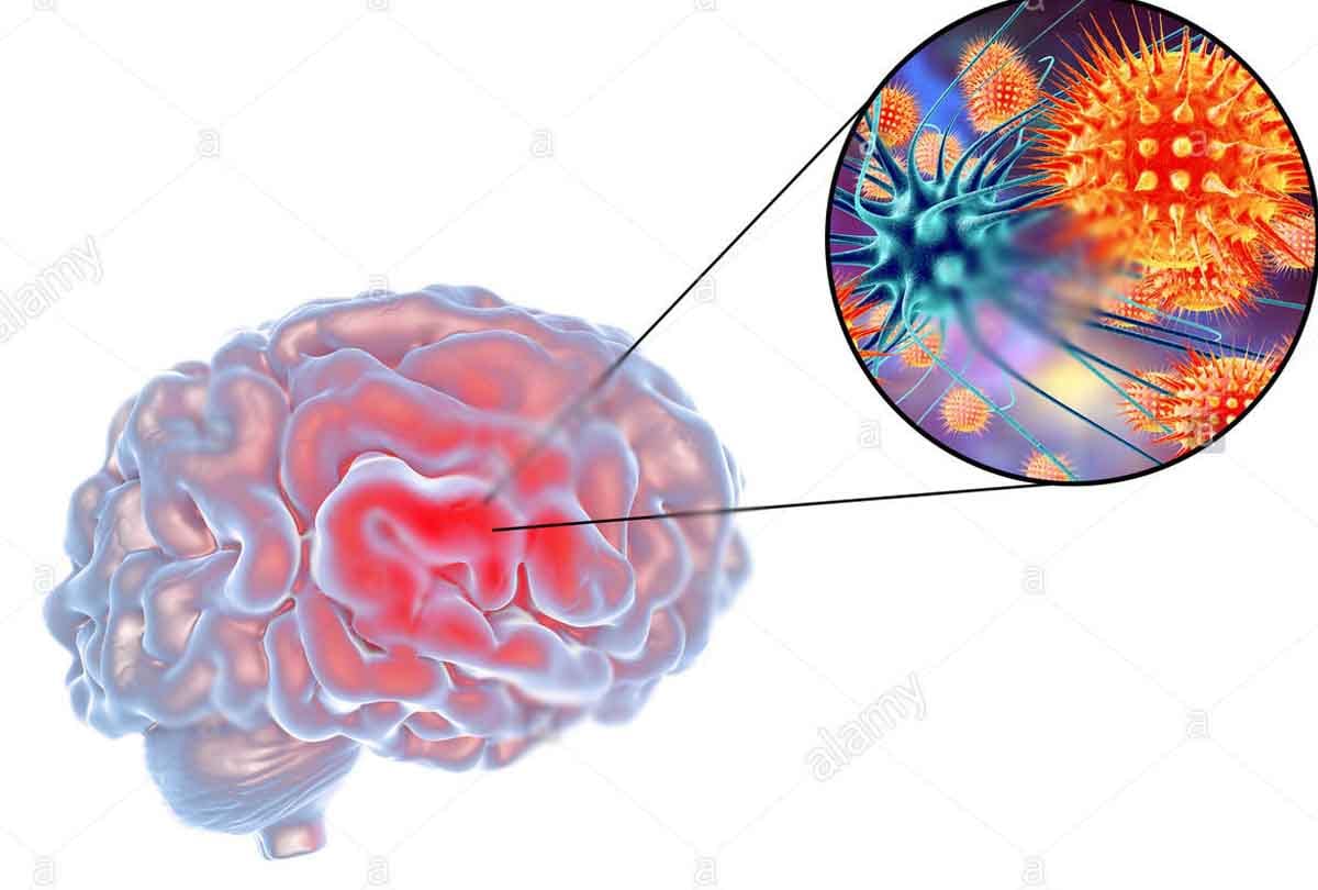 Danger of viral encephalitis spreading
