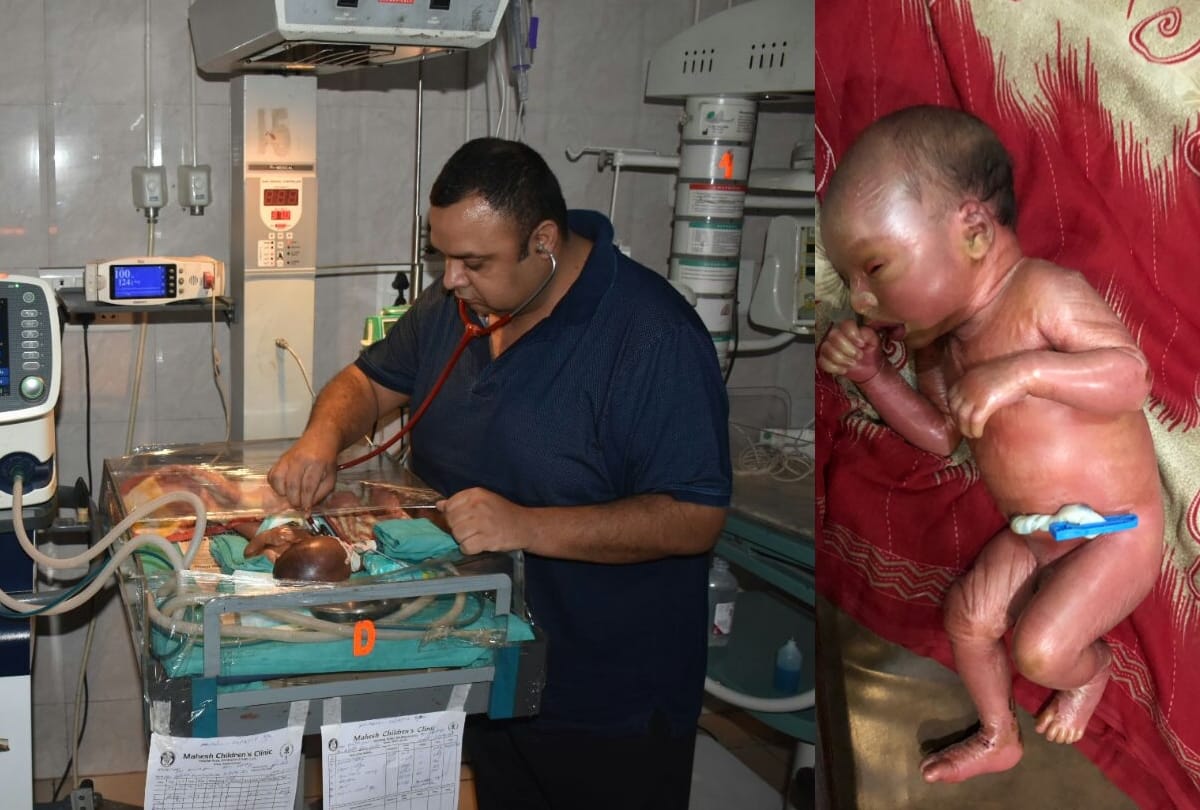 collodion baby born in balrampur uttar pardesh