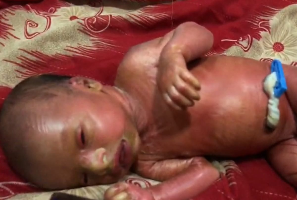 collodion baby born in balrampur uttar pardesh