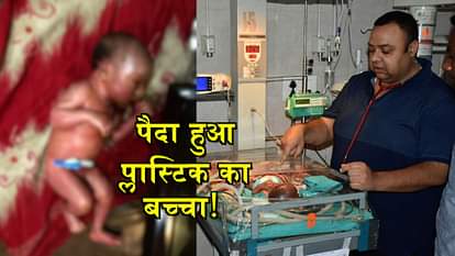 know about collodion baby who born in bahraich