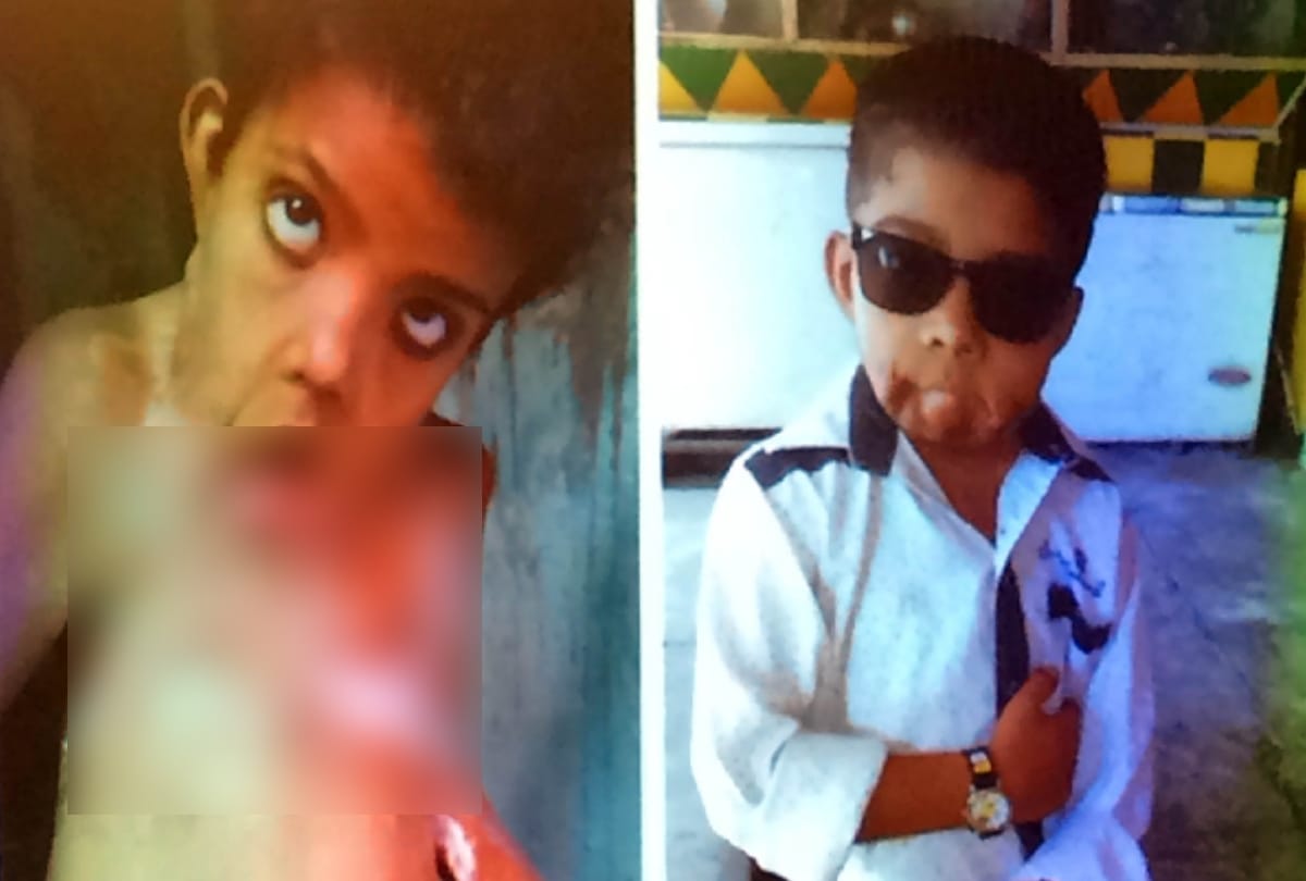 after 4 years of operation of a boy which was stuck in the chest and neck one after the fire 