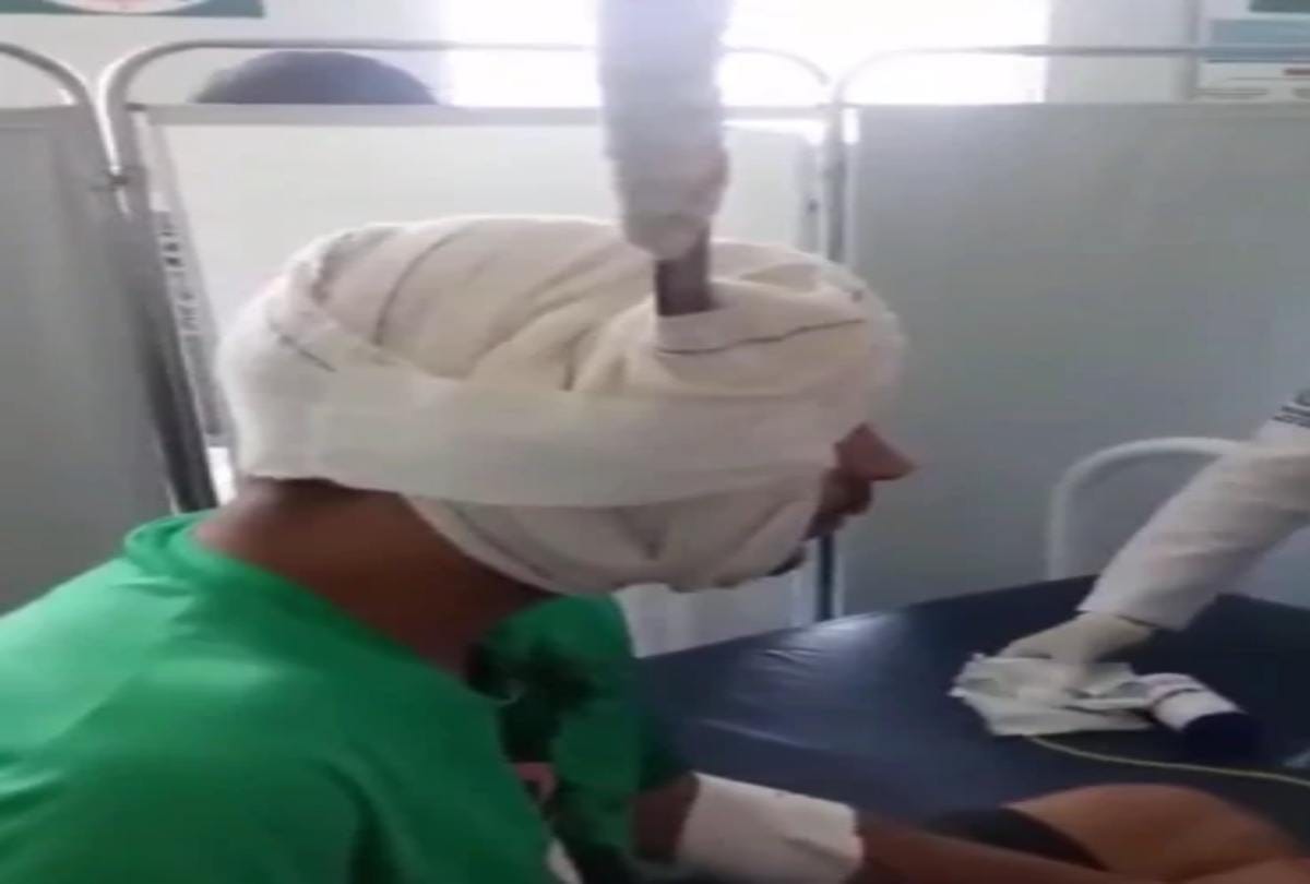 A man walking around machete stuck head at hospital in brazil