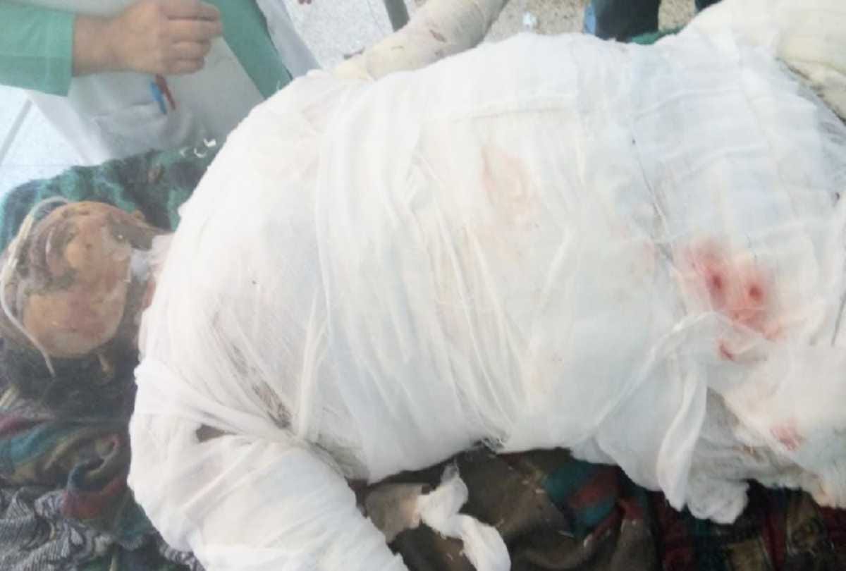 after Scorching in forest fire woman admitted in igmc  died 