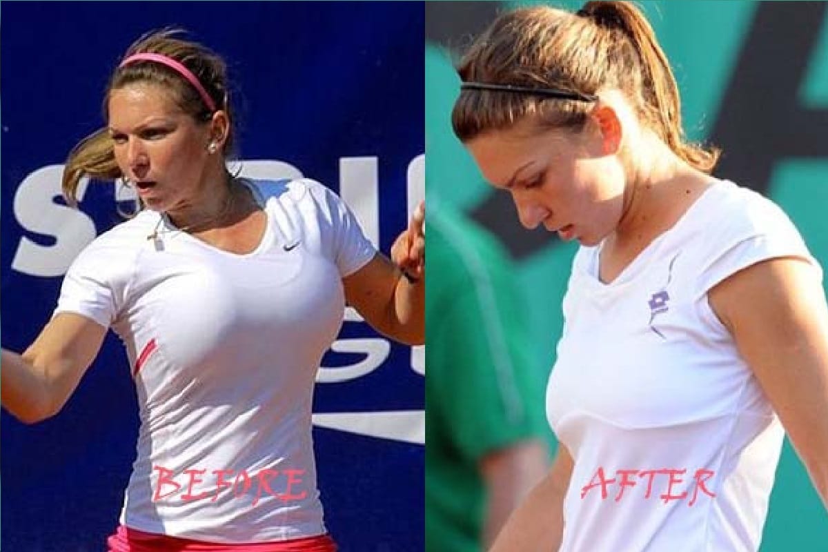 Simona Halep reduce her breast size for being number one in world tennis