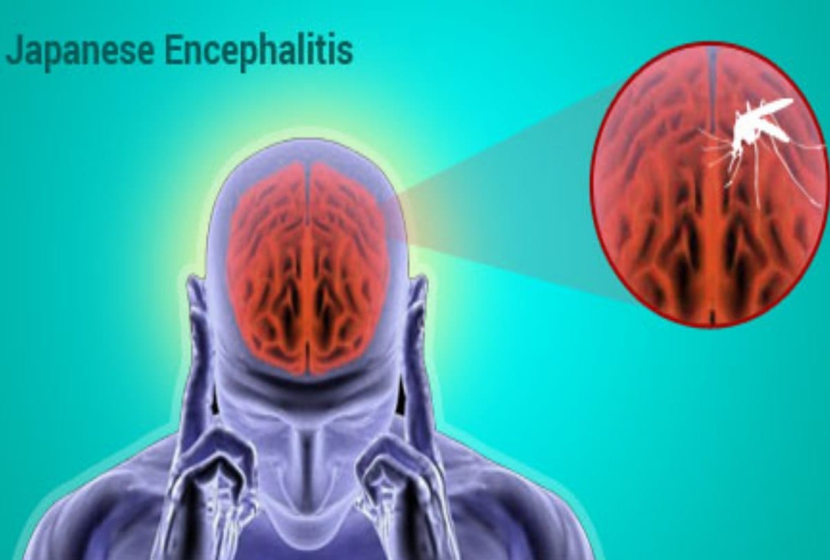 Four more deaths in Assam, Japanese encephalitis in Assam, 100 dead