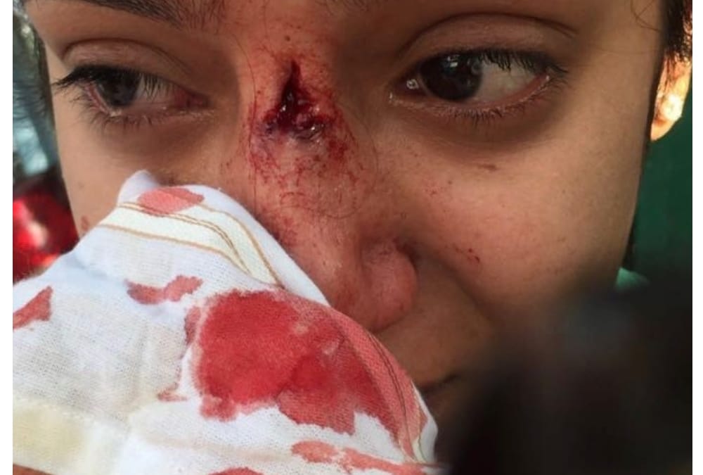 A doctor hits stone on a girl's nose.