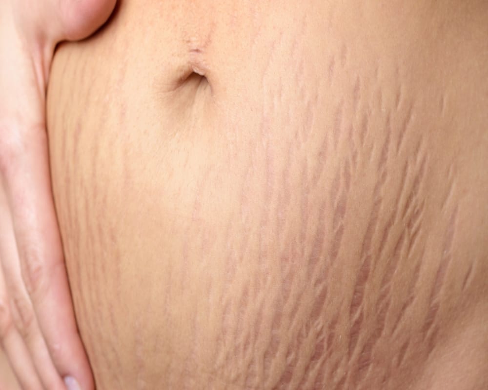 How To Remove Stretch Marks After Delivery Home Remedies In Hindi