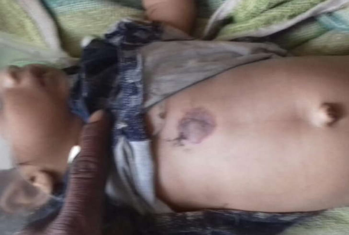 saint burn a sick child with hot bars Due to superstition in Bhilwara, rajasthan