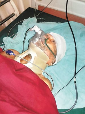 The bulk of the thighs stretches, 42 stitches in the head, severe