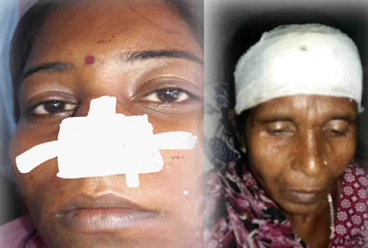 Drunk husband cut his wifes nose