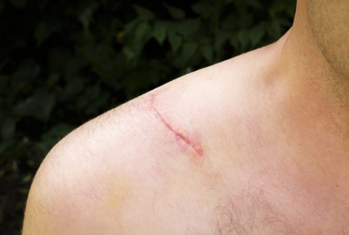 Easy and simple home remedies for Scar Removal