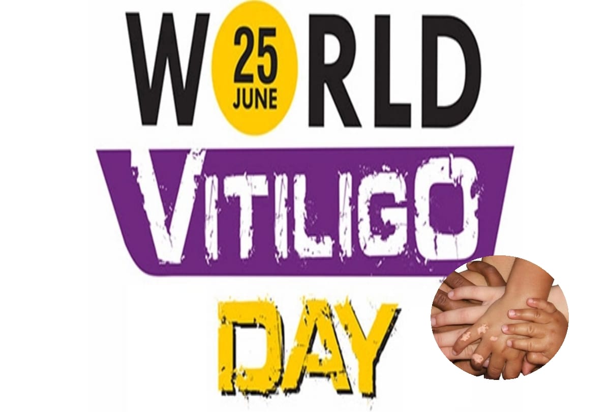 world vitiligo day 2018 special: aiims doctors study says this disease also make mental ill