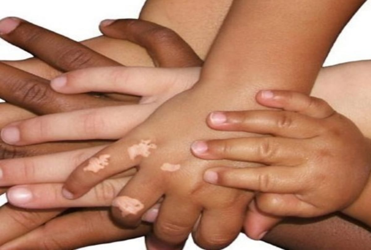 world vitiligo day 2019 time to break stereotypes about white spot disease