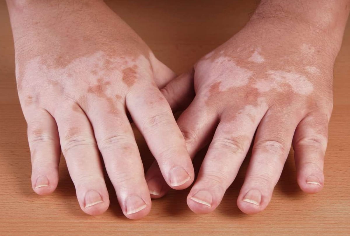 world vitiligo day 2019 time to break stereotypes about white spot disease
