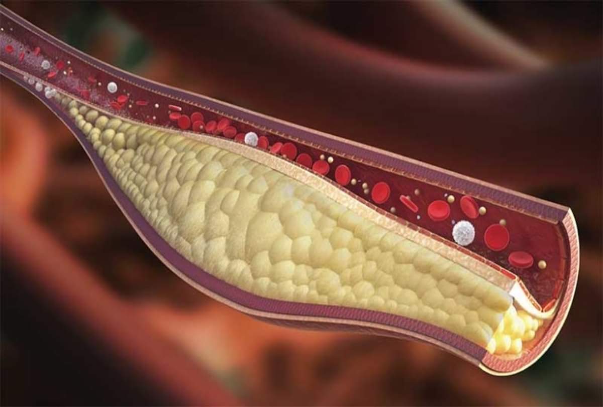 what causes artery blockage What lifestyle leads to arteries problems
