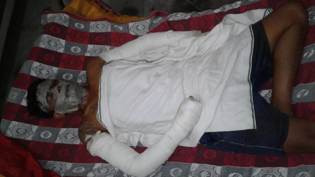 Acid attack on young man before his marriage in firozabad