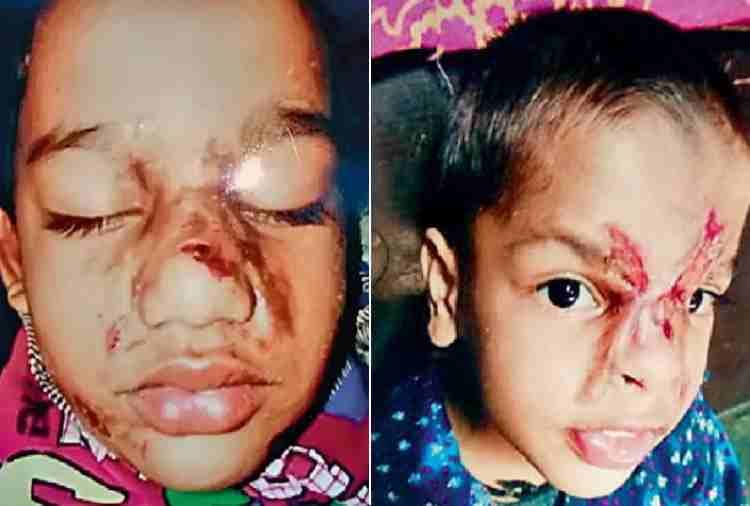 chandigarh, siblings suffering from rare disease, rare case of skin disease