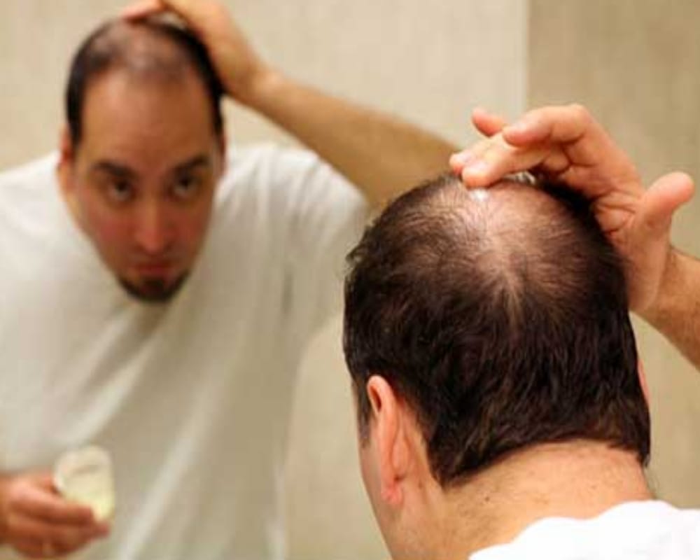 Scientists have discovered TGF-beta  that may lead to the effective treatment of baldness