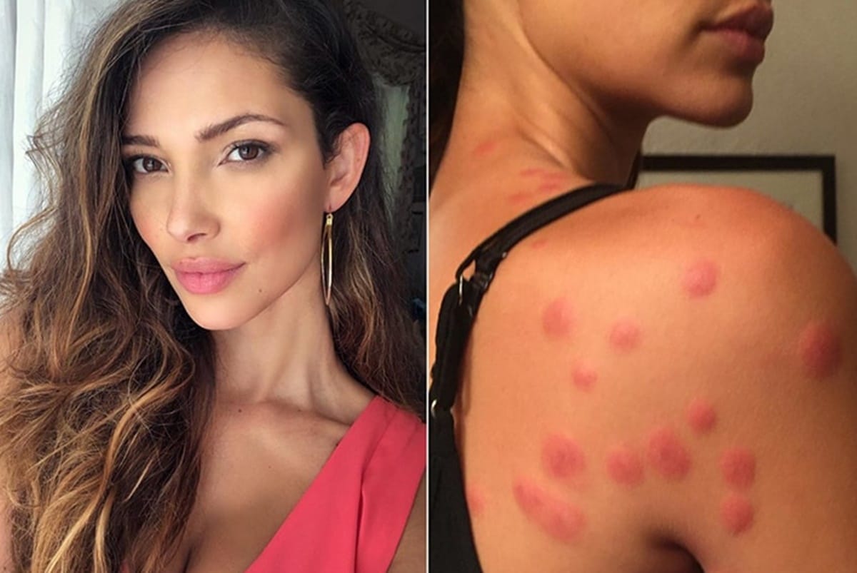 Victoria Secret model Sabrina Jales sues hotel after bedbug bite