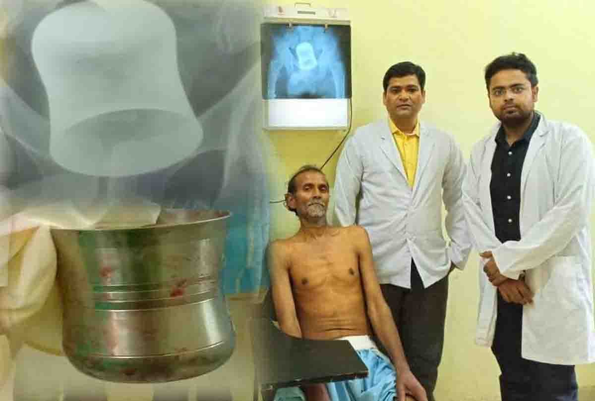 Steel glass out from patient's stomach