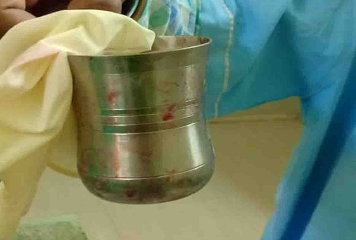 Steel glass out from patient's stomach